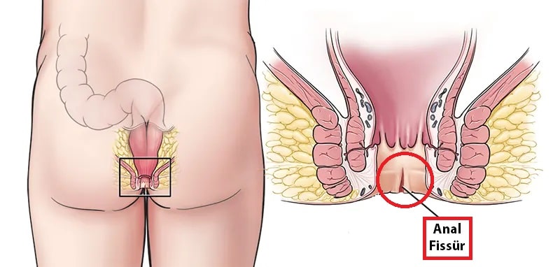 anal fissür - Dr Mutlu Şahin