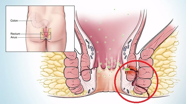 anal fistül - Dr Mutlu Şahin