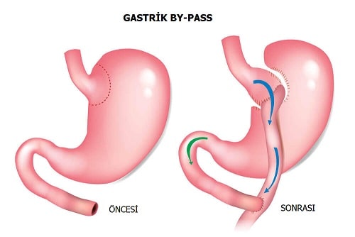 gastrik-bypass - Dr Mutlu Şahin