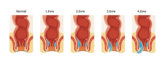 hemoroidin evreleri- Dr Mutlu Şahin