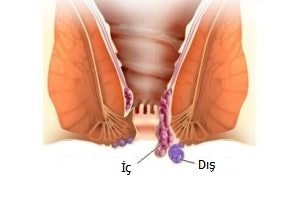 türleri hemoroid (iç/dış) - Dr Mutlu Şahin
