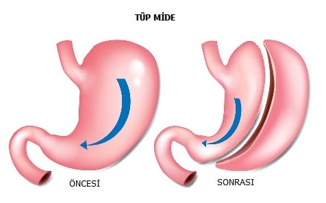 tüp mide - Dr Mutlu Şahin